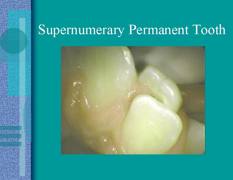 Supernumerary Permanent Tooth 