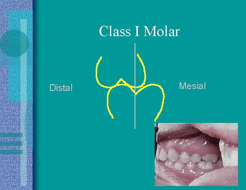 Class I Molar Distal Mesial 