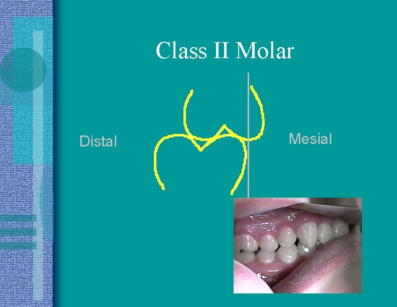 Class II Molar Distal Mesial 