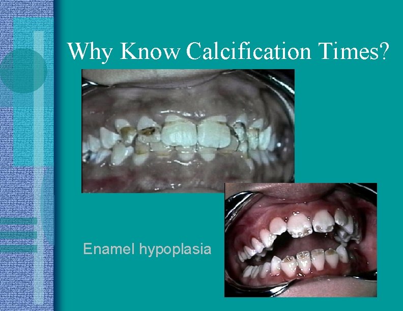 Why Know Calcification Times? Enamel hypoplasia 