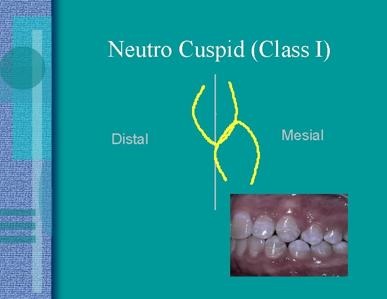 Neutro Cuspid (Class I) Distal Mesial 
