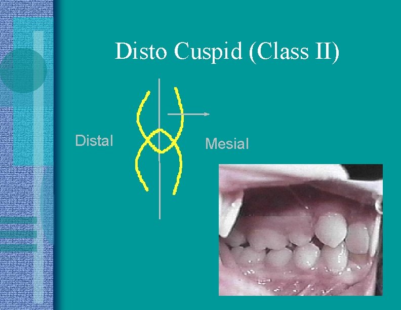 Disto Cuspid (Class II) Distal Mesial 