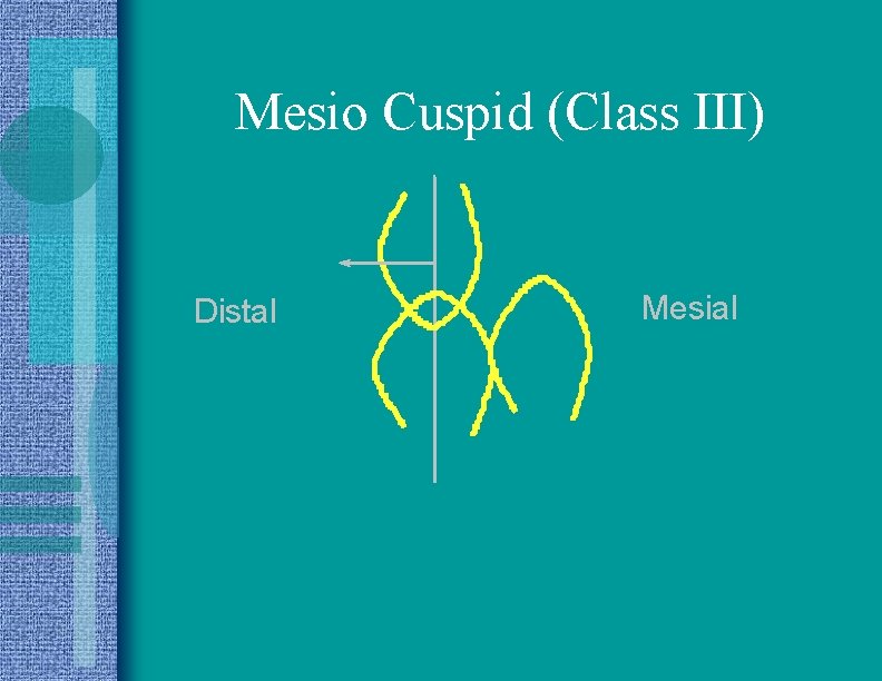 Mesio Cuspid (Class III) Distal Mesial 