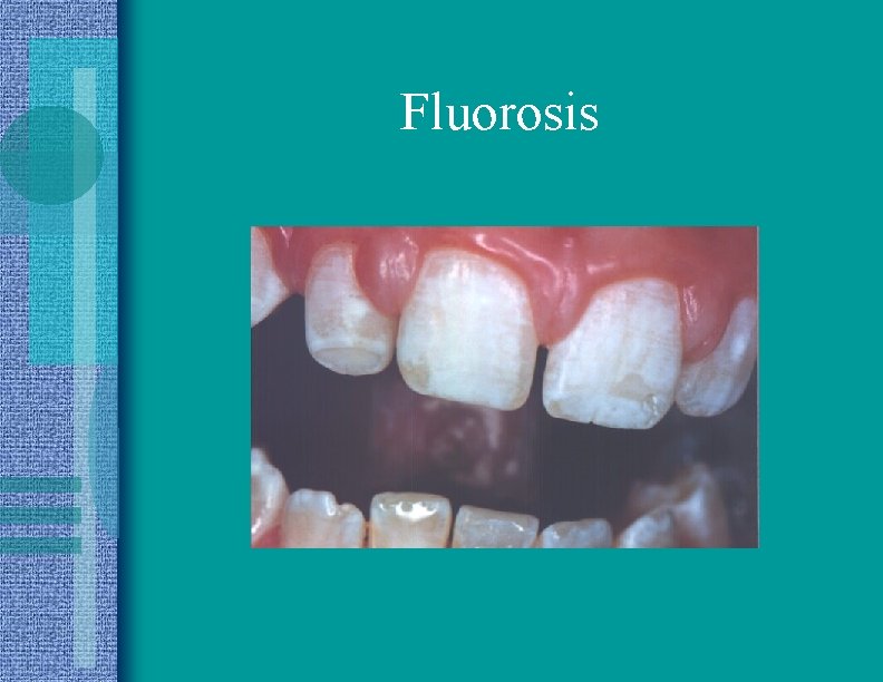 Fluorosis 