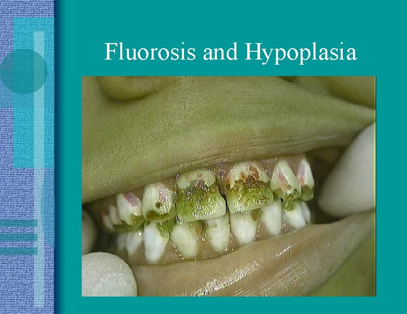 Fluorosis and Hypoplasia 