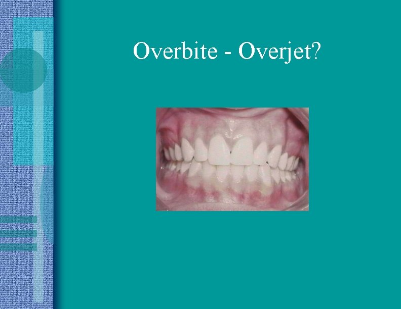 Overbite - Overjet? 
