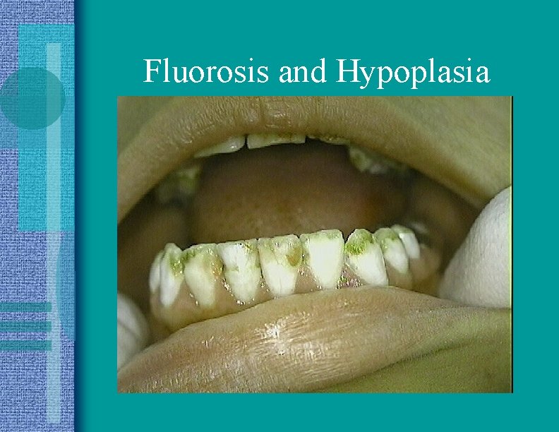 Fluorosis and Hypoplasia 