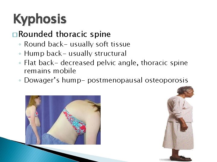 Kyphosis � Rounded thoracic spine ◦ Round back- usually soft tissue ◦ Hump back-