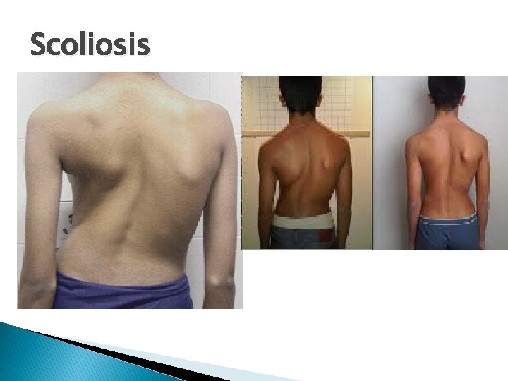 Scoliosis 