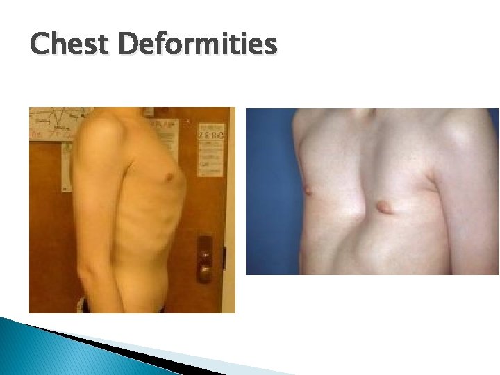 Chest Deformities 