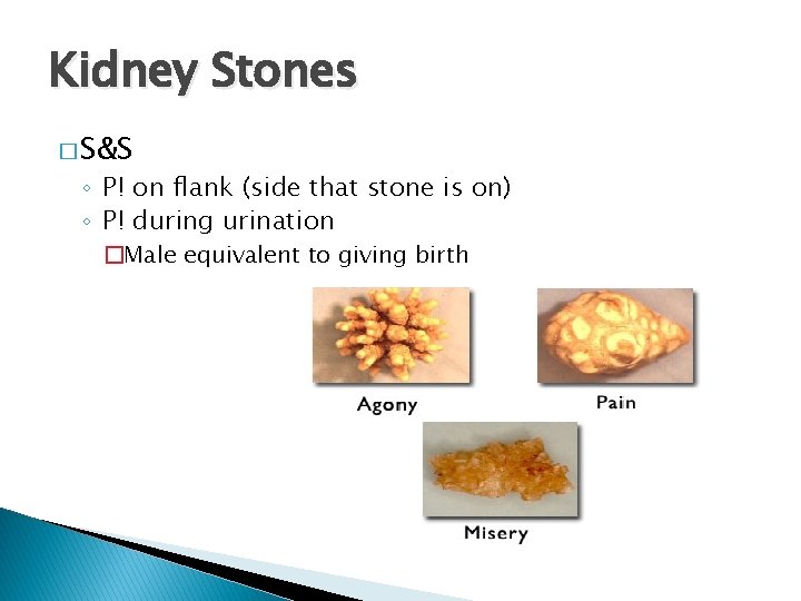 Kidney Stones � S&S ◦ P! on flank (side that stone is on) ◦