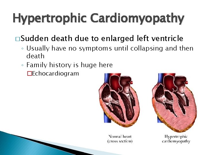 Hypertrophic Cardiomyopathy � Sudden death due to enlarged left ventricle ◦ Usually have no