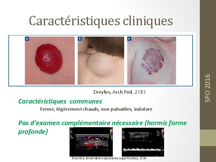 Dreyfus, Arch Ped, 2013 Caractéristiques communes Ferme, légèrement chauds, non pulsatiles, indolore Pas d’examen