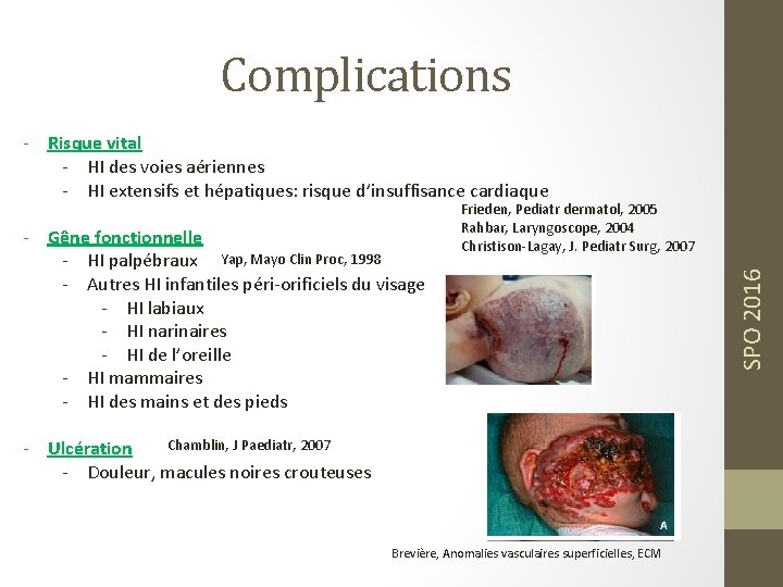 Complications - Risque vital - HI des voies aériennes - HI extensifs et hépatiques: