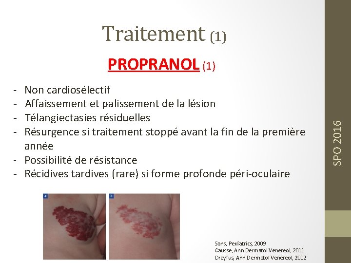 Traitement (1) - Non cardiosélectif - Affaissement et palissement de la lésion - Télangiectasies