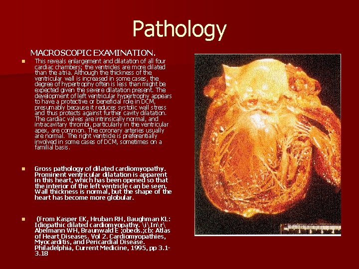 Pathology MACROSCOPIC EXAMINATION. n This reveals enlargement and dilatation of all four cardiac chambers;