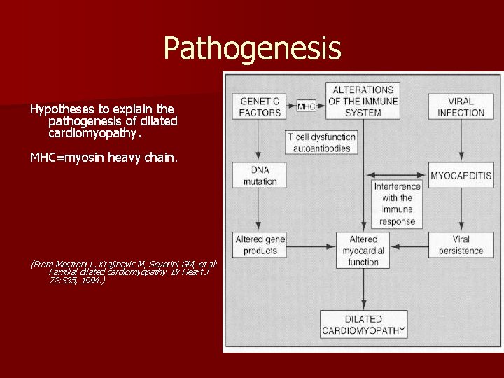 Pathogenesis Hypotheses to explain the pathogenesis of dilated cardiomyopathy. MHC=myosin heavy chain. (From Mestroni