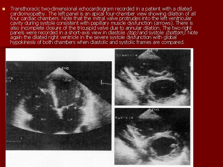 n Transthoracic two-dimensional echocardiogram recorded in a patient with a dilated cardiomyopathy. The left