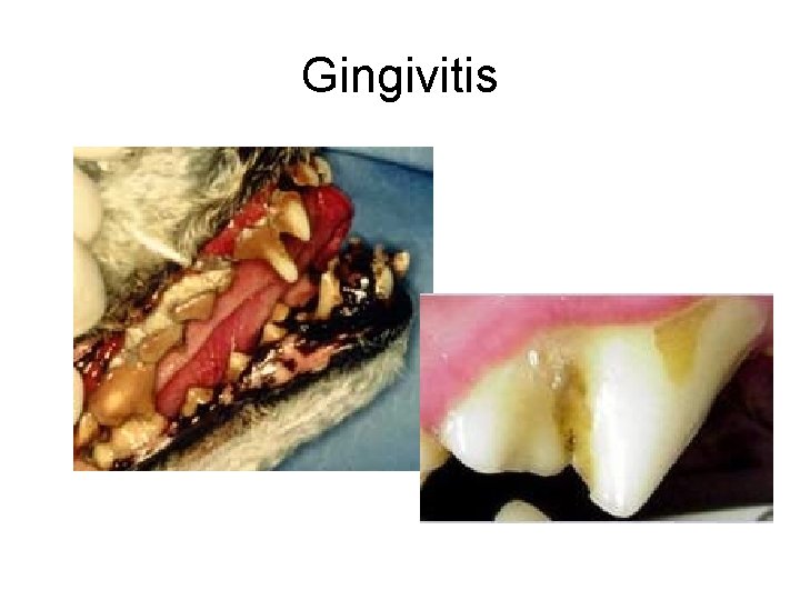 Gingivitis 