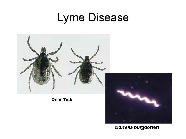 Lyme Disease Deer Tick Borrelia burgdorferi 