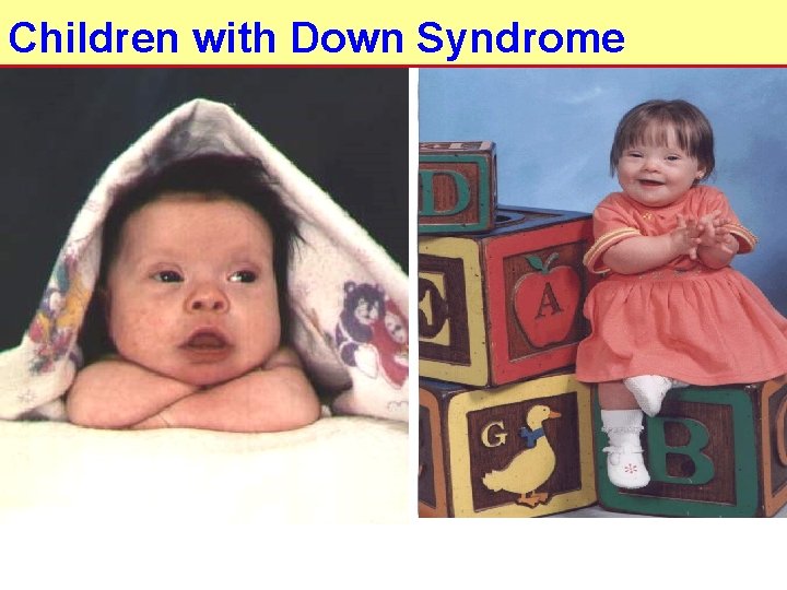 Children with Down Syndrome 