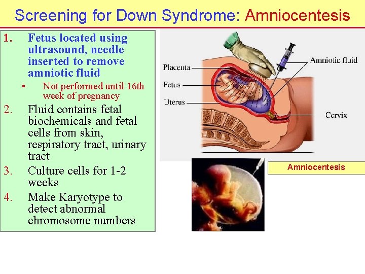 Screening for Down Syndrome: Amniocentesis 1. Fetus located using ultrasound, needle inserted to remove