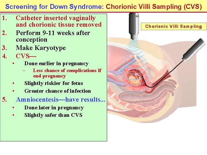 Screening for Down Syndrome: Chorionic Villi Sampling (CVS) 1. Catheter inserted vaginally and chorionic