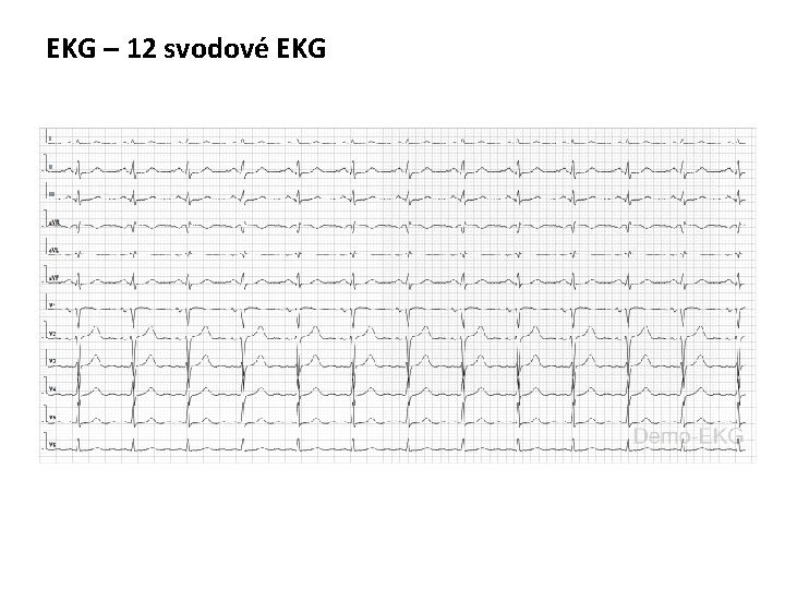 EKG – 12 svodové EKG 
