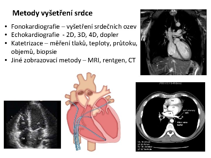 Metody vyšetření srdce • Fonokardiografie – vyšetření srdečních ozev • Echokardiografie - 2 D,