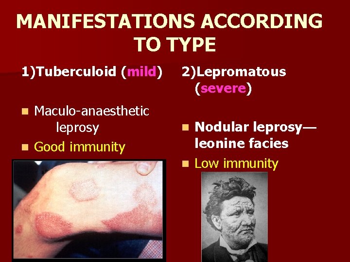 MANIFESTATIONS ACCORDING TO TYPE 1)Tuberculoid (mild) Maculo-anaesthetic leprosy n Good immunity n 2)Lepromatous (severe)