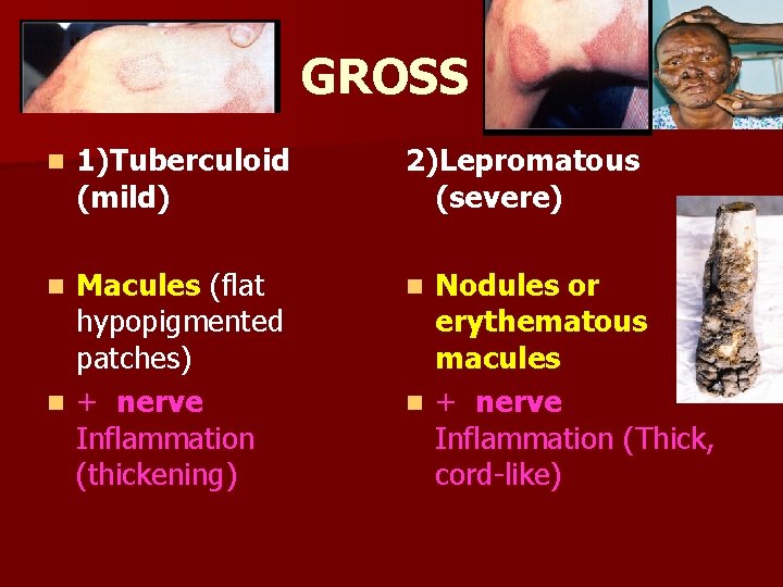 GROSS n 1)Tuberculoid (mild) Macules (flat hypopigmented patches) n + nerve Inflammation (thickening) n