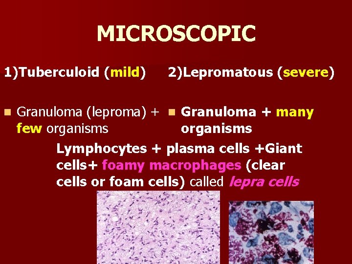 MICROSCOPIC 1)Tuberculoid (mild) n 2)Lepromatous (severe) Granuloma (leproma) + n Granuloma + many few