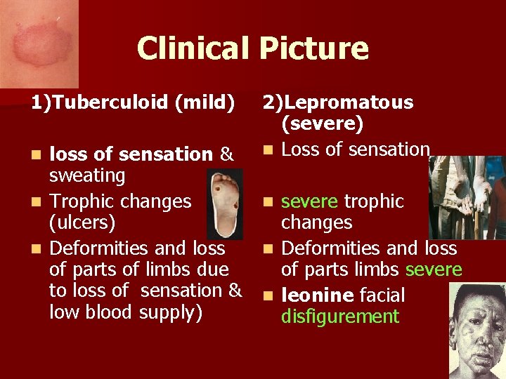 Clinical Picture 1)Tuberculoid (mild) 2)Lepromatous (severe) n Loss of sensation loss of sensation &