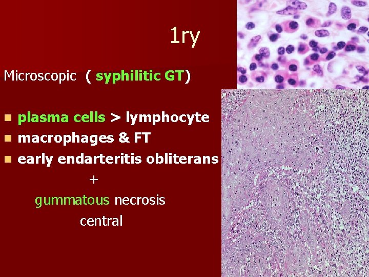 1 ry Microscopic ( syphilitic GT) plasma cells > lymphocyte n macrophages & FT