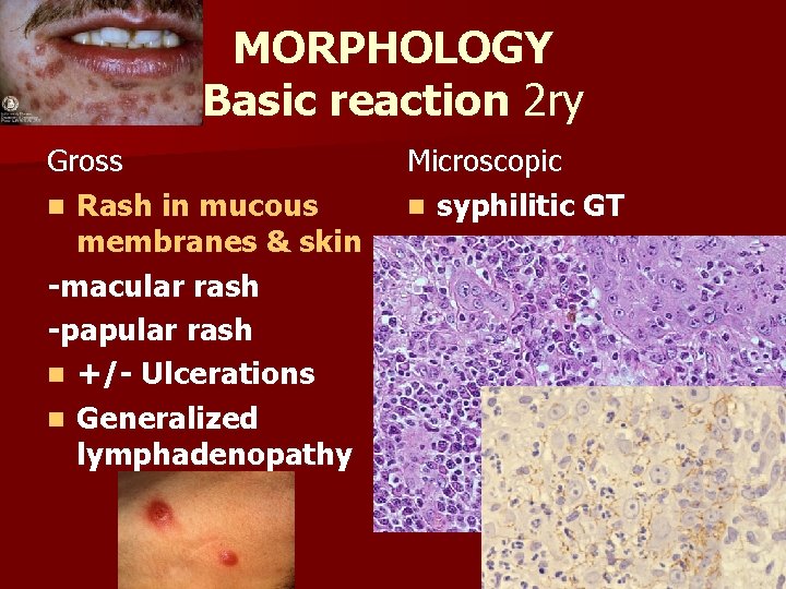 MORPHOLOGY Basic reaction 2 ry Gross n Rash in mucous membranes & skin -macular
