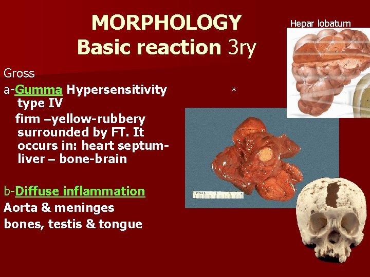 MORPHOLOGY Basic reaction 3 ry Gross a-Gumma Hypersensitivity type IV firm –yellow-rubbery surrounded by