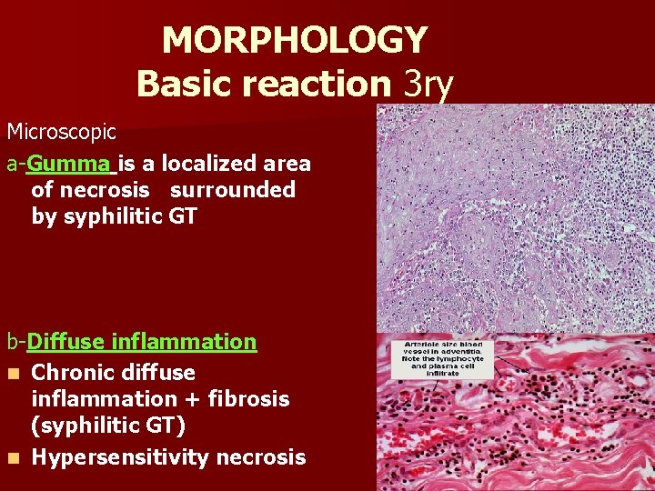 MORPHOLOGY Basic reaction 3 ry Microscopic a-Gumma is a localized area of necrosis surrounded