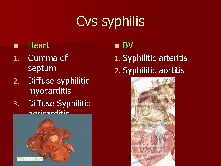 Cvs syphilis Heart 1. Gumma of septum 2. Diffuse syphilitic myocarditis 3. Diffuse Syphilitic