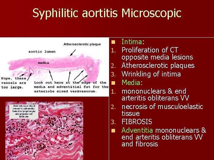 Syphilitic aortitis Microscopic n gross n 1. 2. 3. n Intima: Proliferation of CT