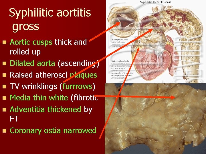 Syphilitic aortitis gross n n n n Aortic cusps thick and rolled up Dilated