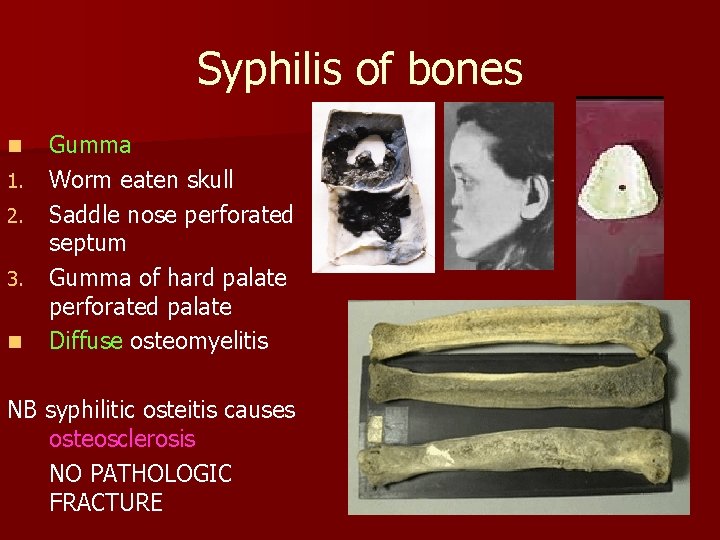 Syphilis of bones n 1. 2. 3. n Gumma Worm eaten skull Saddle nose