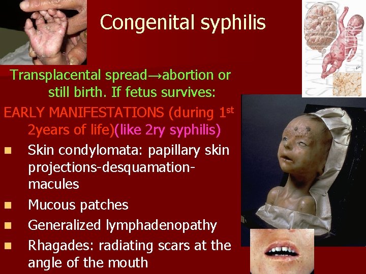 Congenital syphilis Transplacental spread→abortion or still birth. If fetus survives: EARLY MANIFESTATIONS (during 1
