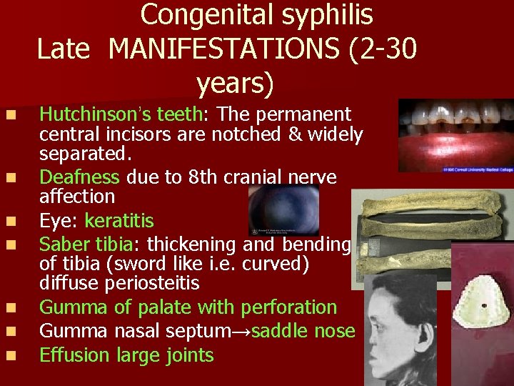Congenital syphilis Late MANIFESTATIONS (2 -30 years) n n n n Hutchinson’s teeth: The