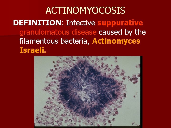 ACTINOMYOCOSIS DEFINITION: Infective suppurative granulomatous disease caused by the filamentous bacteria, Actinomyces Israeli. 