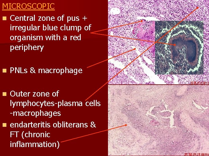 MICROSCOPIC n Central zone of pus + irregular blue clump of organism with a