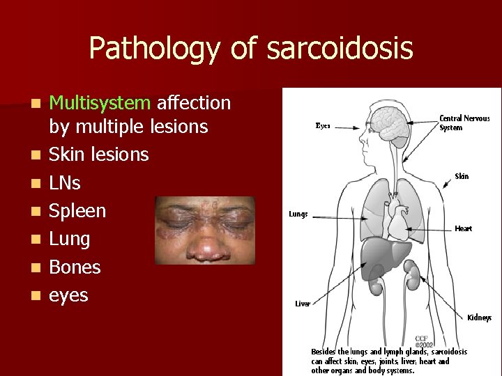 Pathology of sarcoidosis n n n n Multisystem affection by multiple lesions Skin lesions