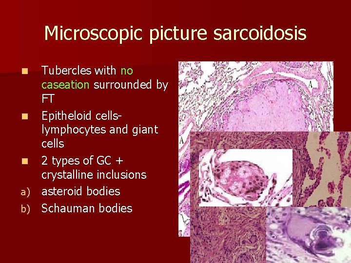 Microscopic picture sarcoidosis Tubercles with no caseation surrounded by FT n Epitheloid cellslymphocytes and