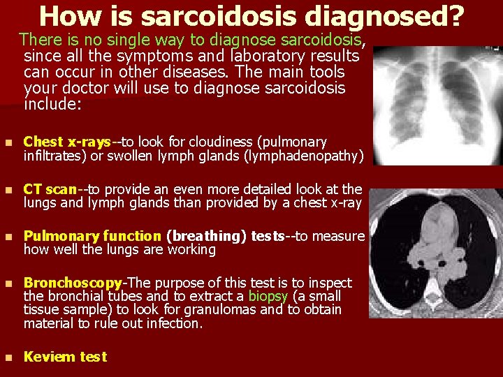 How is sarcoidosis diagnosed? There is no single way to diagnose sarcoidosis, since all