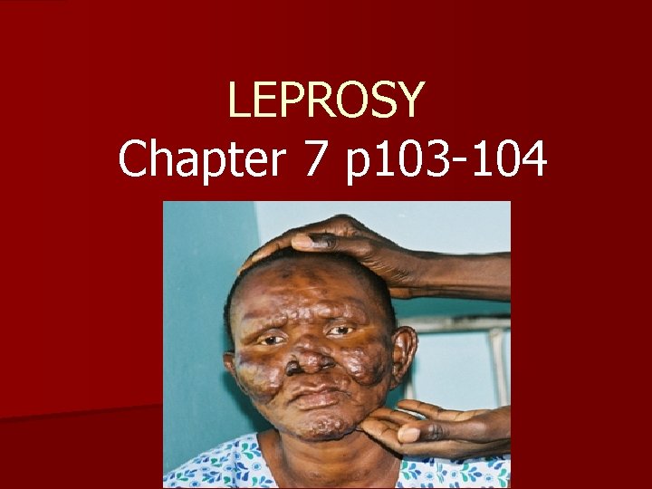 LEPROSY Chapter 7 p 103 -104 