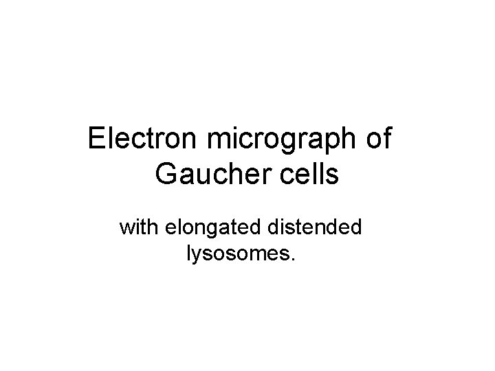 Electron micrograph of Gaucher cells with elongated distended lysosomes. 